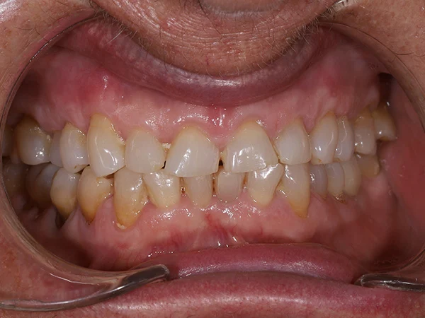caso dental carillas antes dentista en el casar