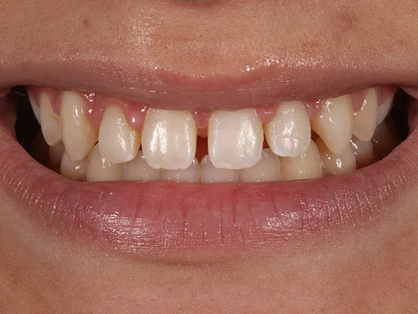 caso dental carillas composite antes dentista en el casar