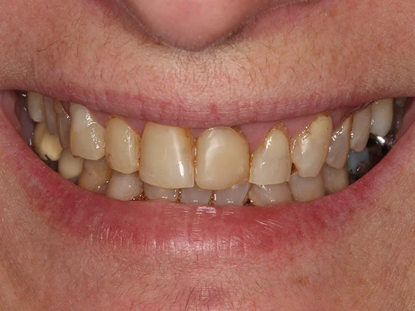 caso dental carillas porcelana antes dentista en el casar